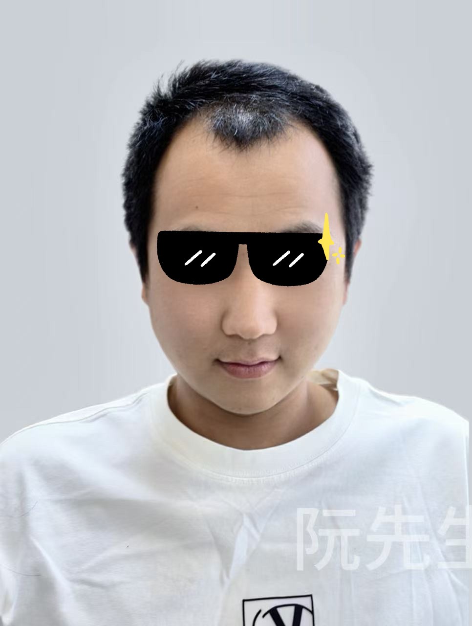 佩戴前：局部稀疏 / 斑秃